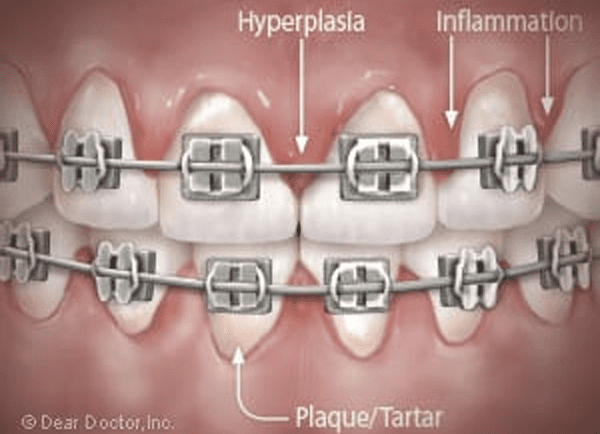 Your Gums May Need A Little Extra Care While You’re Wearing Braces