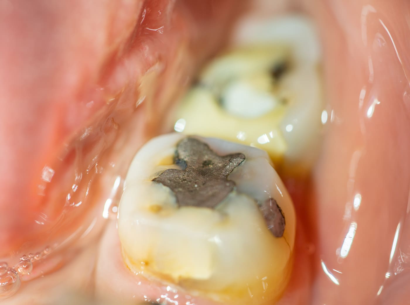 Filling in back tooth closeup macro view