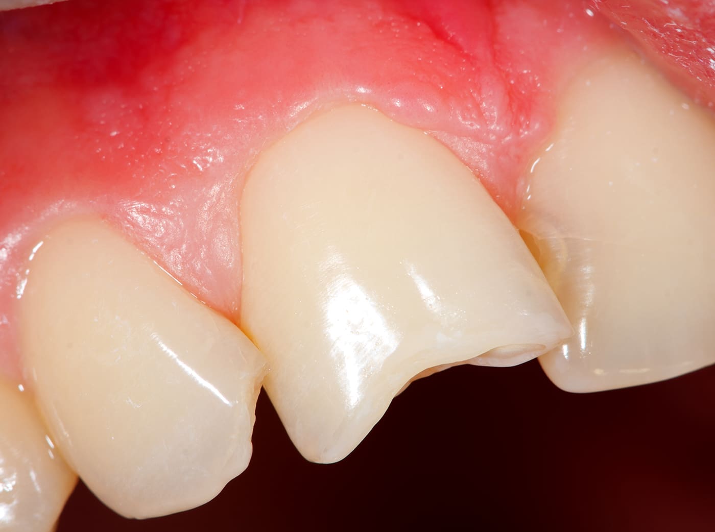 closeup of fractured tooth that will need a dental crown