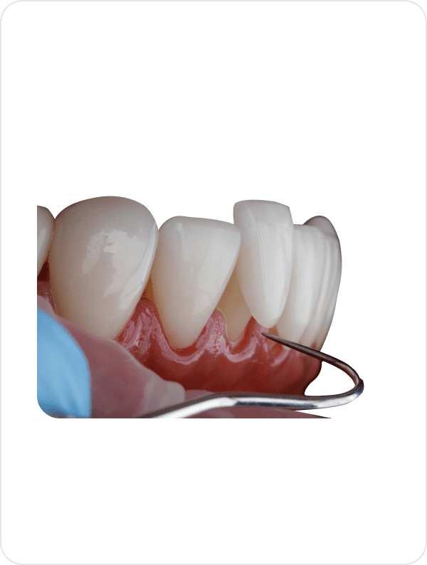 Ultra Thin tooth Veneers