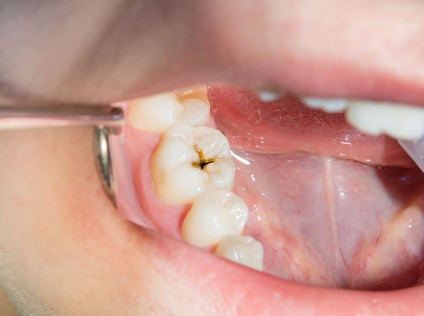 close-up of a human rotten carious tooth at the treatment stage