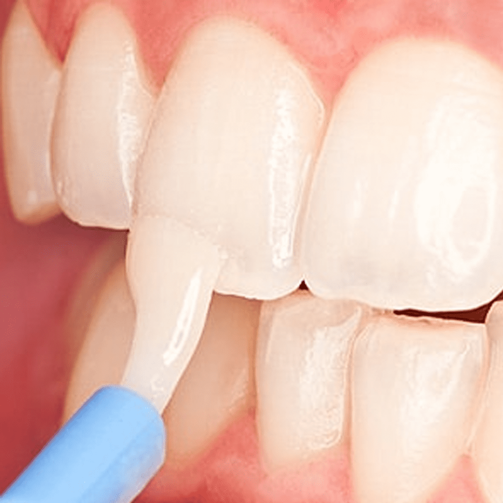 A Topical Fluoride Treatment Could Protect Your Child From Tooth Decay