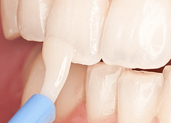 A Topical Fluoride Treatment Could Protect Your Child From Tooth Decay