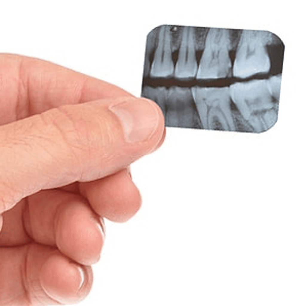 Bitewing X-Rays Provide Early Detection Of Tooth Decay In Back Teeth