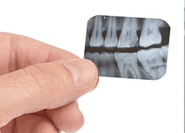 Bitewing X-Rays Provide Early Detection Of Tooth Decay In Back Teeth