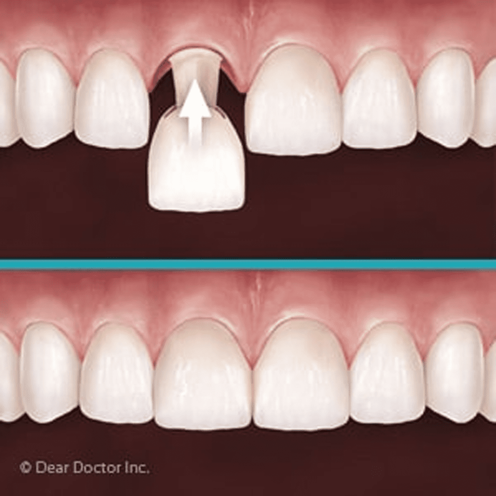 Customized Temporary Crowns Help Ensure A Satisfying Permanent Smile