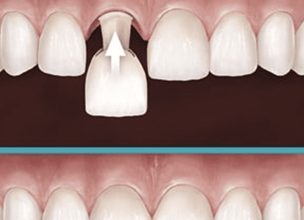 Customized Temporary Crowns Help Ensure A Satisfying Permanent Smile