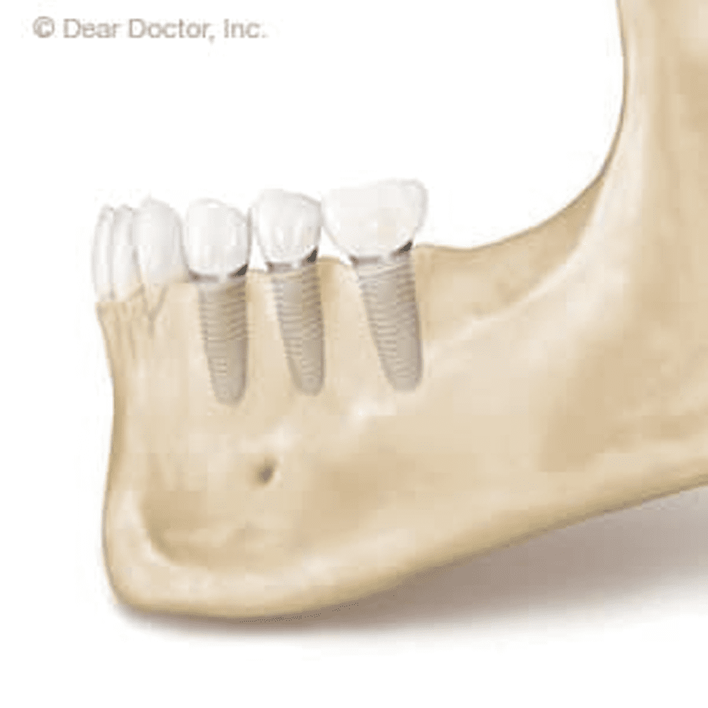 Dental Implants Help Maintain Bone Health