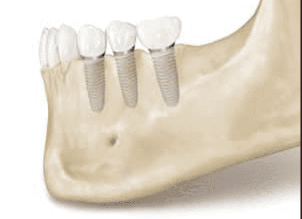 Dental Implants Help Maintain Bone Health