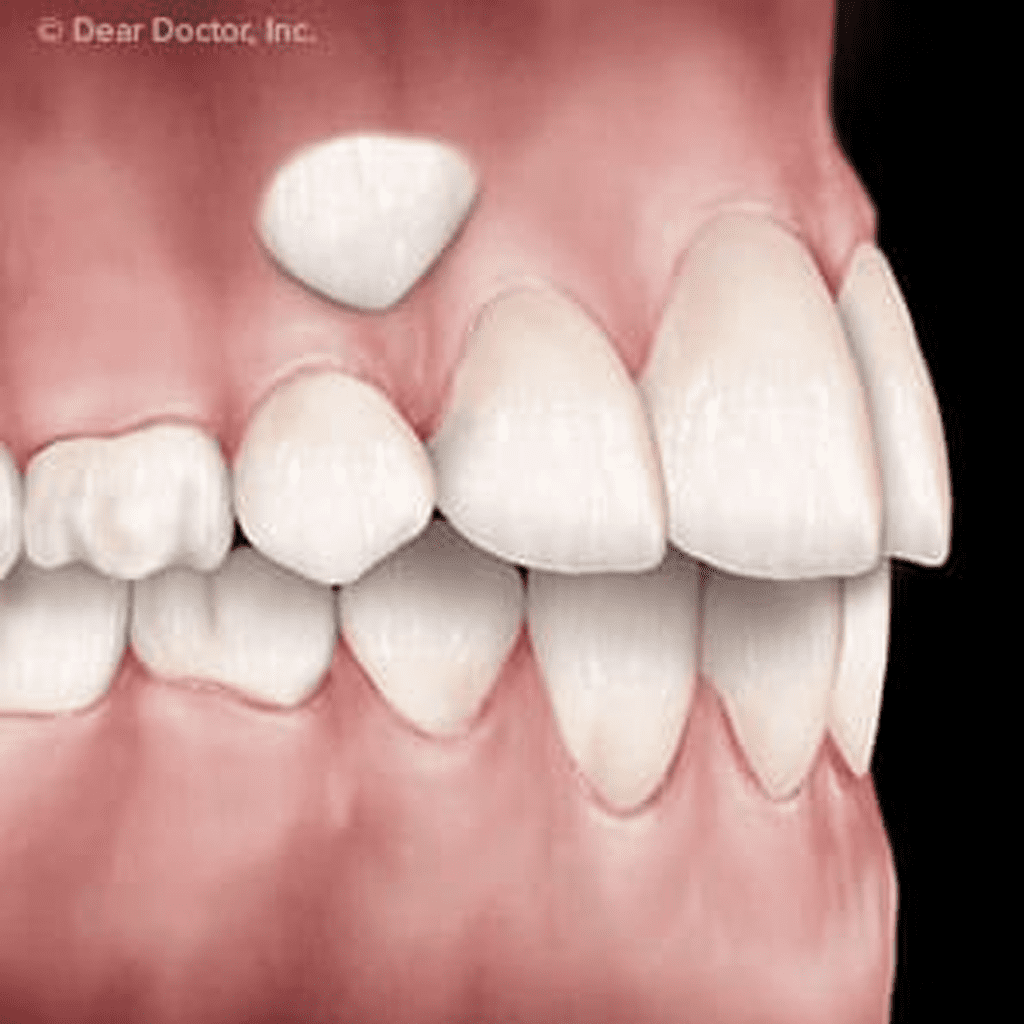 Drawing Impacted Teeth Into The Open Can Restore A Smile