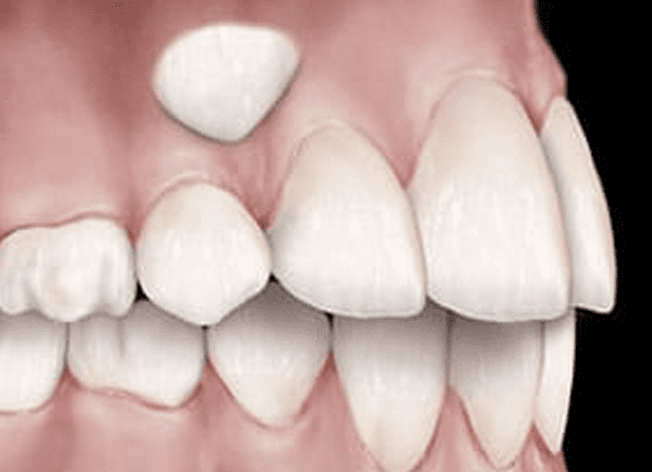 Drawing Impacted Teeth Into The Open Can Restore A Smile