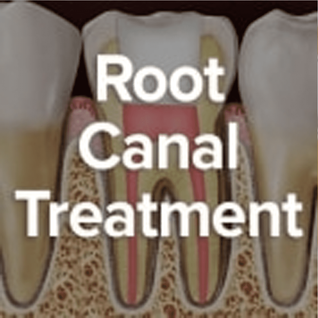 Endodontic Treatment Could Save A Tooth In Crisis