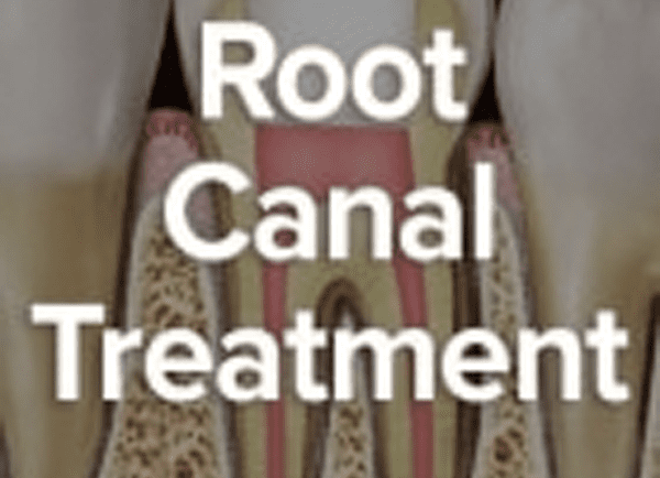 Endodontic Treatment Could Save A Tooth In Crisis