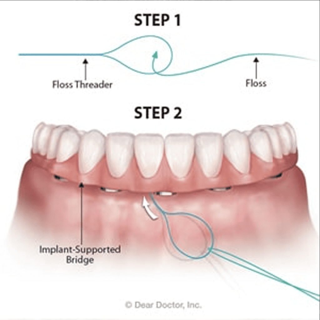 Flossing Daily Around Implants Will Help Prevent Losing Your Bridge