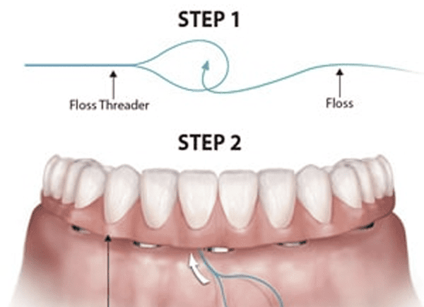 Flossing Daily Around Implants Will Help Prevent Losing Your Bridge