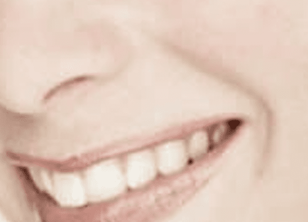 Gum Disease (Gingivitis)