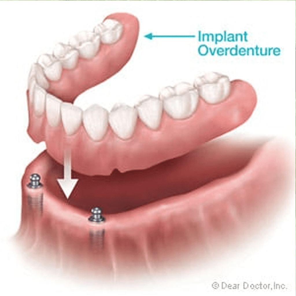 Implant-Supported Dentures – A Better Fit With Excessive Bone Loss