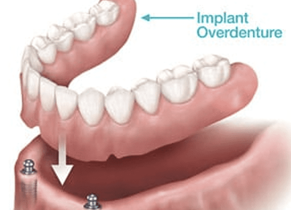 Implant-Supported Dentures – A Better Fit With Excessive Bone Loss
