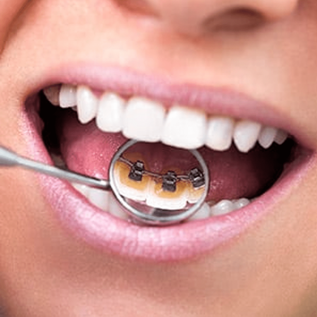 Lingual Braces: A Third Choice For Moving Teeth