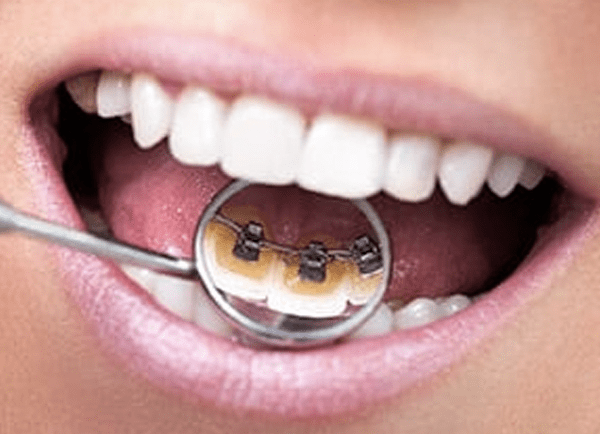 Lingual Braces: A Third Choice For Moving Teeth