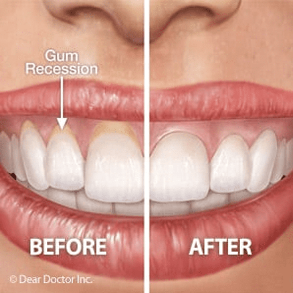Overcoming Gum Recession Will Restore Dental Health And Your Smile