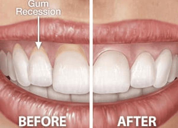 Overcoming Gum Recession Will Restore Dental Health And Your Smile