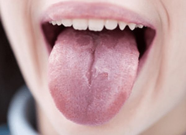 Those Red Patches On Your Tongue Are Nothing To Be Alarmed About