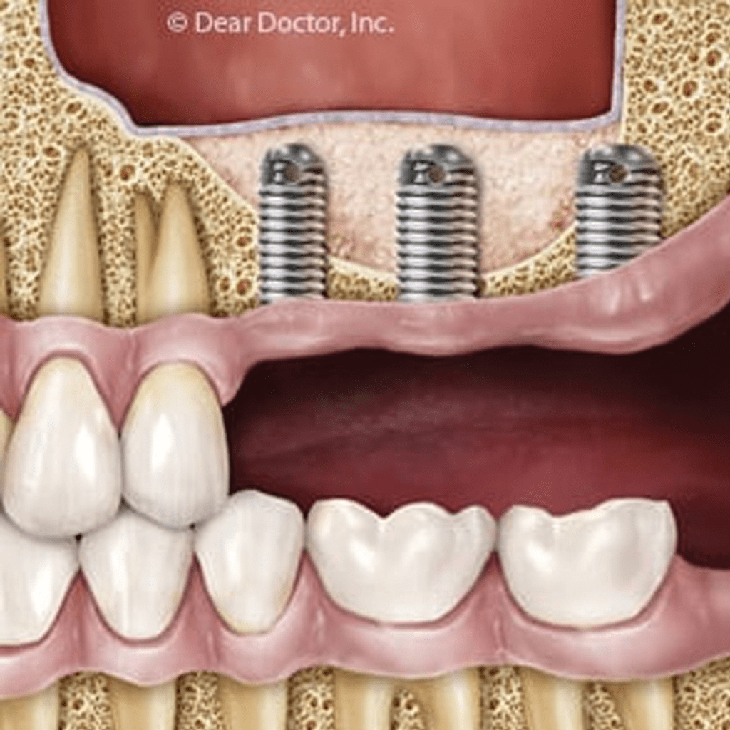 Using Sinus Surgery To Stimulate Bone Growth For Implants