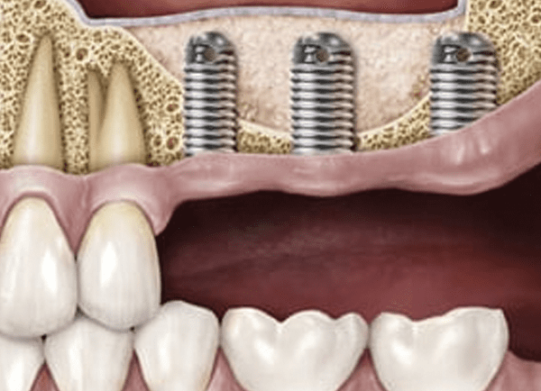 Using Sinus Surgery To Stimulate Bone Growth For Implants