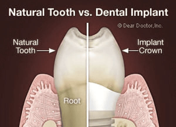 What’s So Special About Dental Implants?