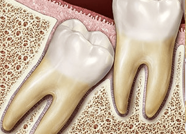 Wisdom Teeth Warrant Close Watch To Avoid Future Health Issues