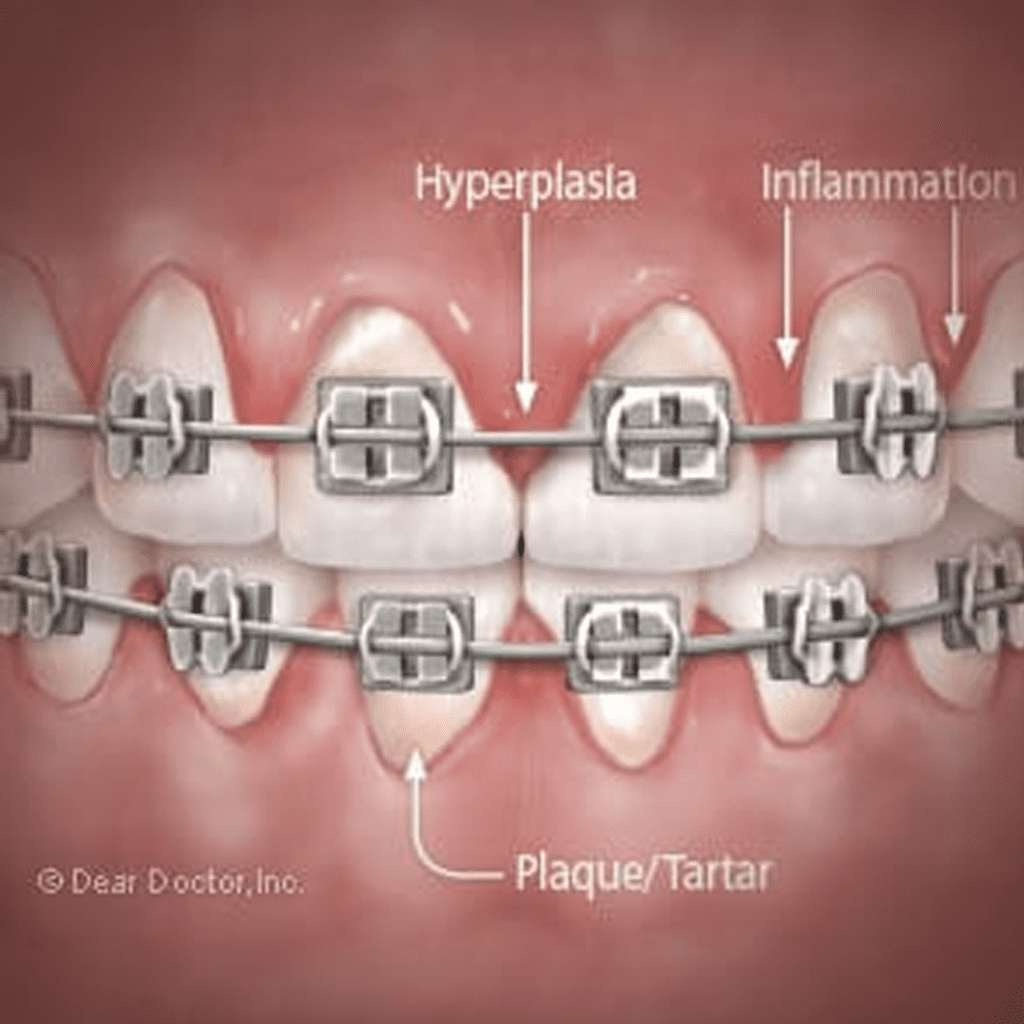 Your Gums May Need A Little Extra Care While You’re Wearing Braces